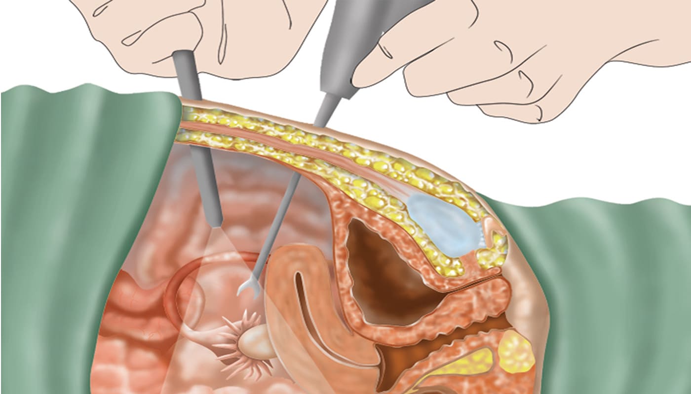 Laparoscopic Vesicovaginal Fistula (VVF) Treatment