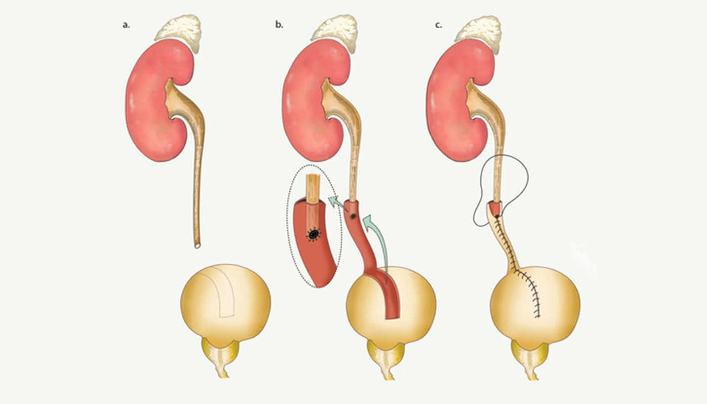 Ureteral Reimplantation Treatment